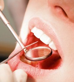 What to expect with dental deep cleaning