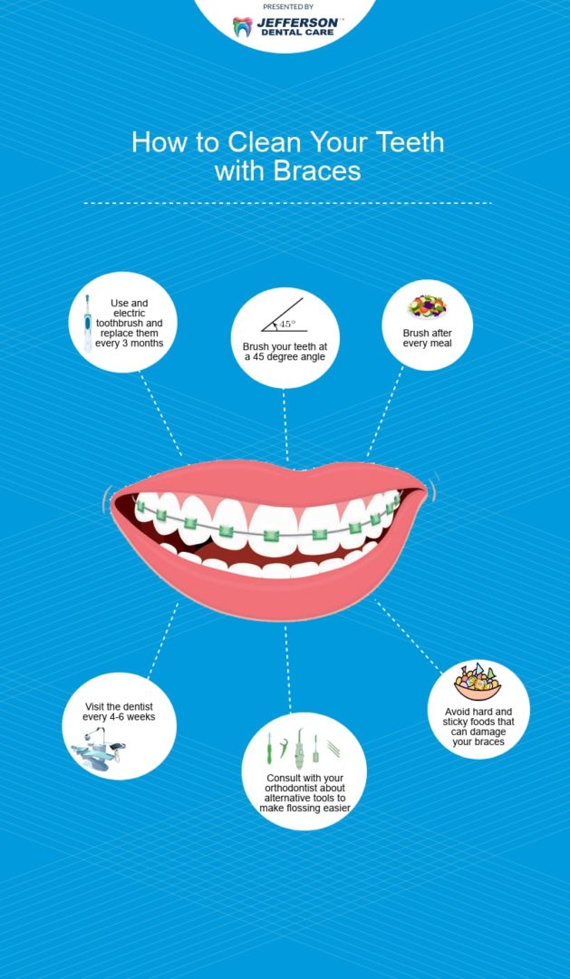 How to Clean Your Teeth with Braces