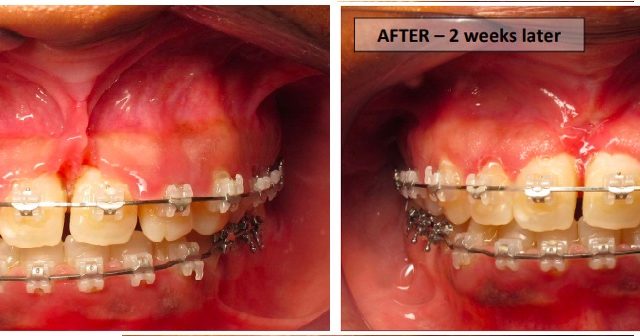 Frenectomy before and after