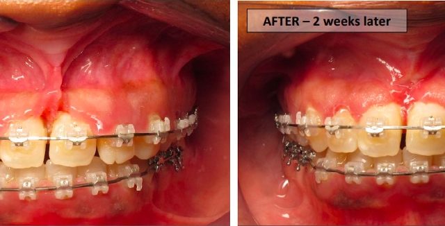 Frenectomy before and after