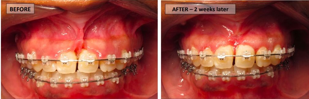 Frenectomy before and after