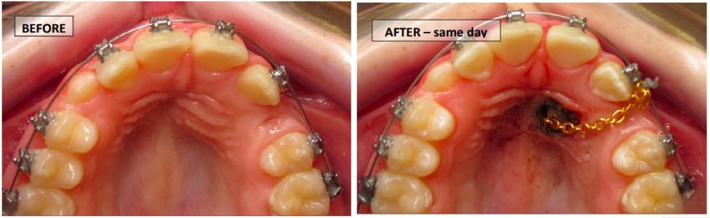 exposure and bonding before and after