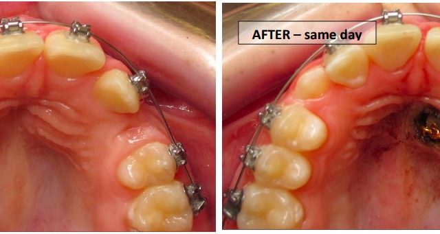 exposure and bonding before and after